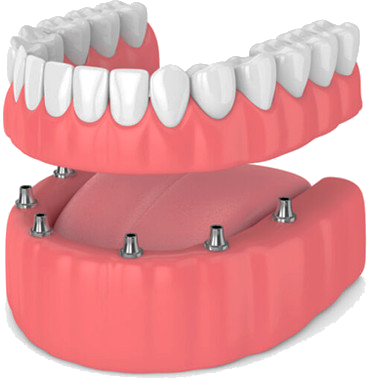 Prótesis Sobre Implantes