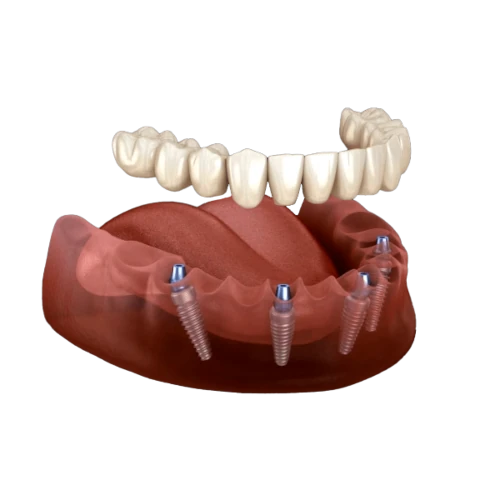 Implantes dentales Sorrifacil